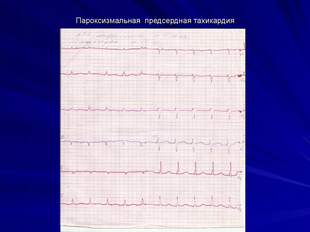 Тахикардия в вертикальном положении. Предсердная пароксизмальная тахикардия на экг. многоочаговая предсердная тахикардия. предсердная тахикардия на экг. пароксизм на экг.