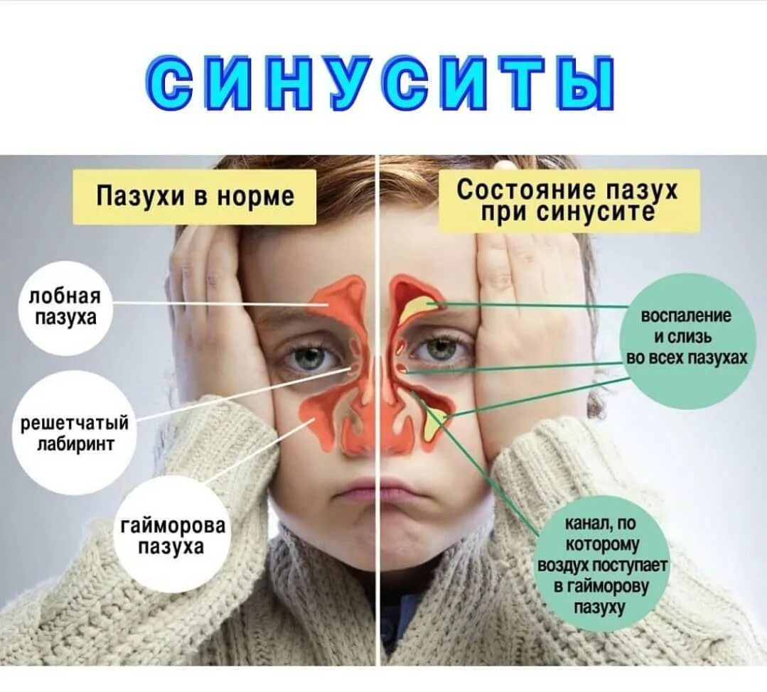 Гайморовых пазух слизистой оболочки