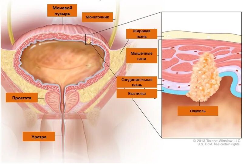 Паравезикальная клетчатка. Опухоль мочевого пузыря. Клтчатки мочевого пузыр. Онкология мочевого пузыря. Переходно клеточные опухоли мочевого пузыря.