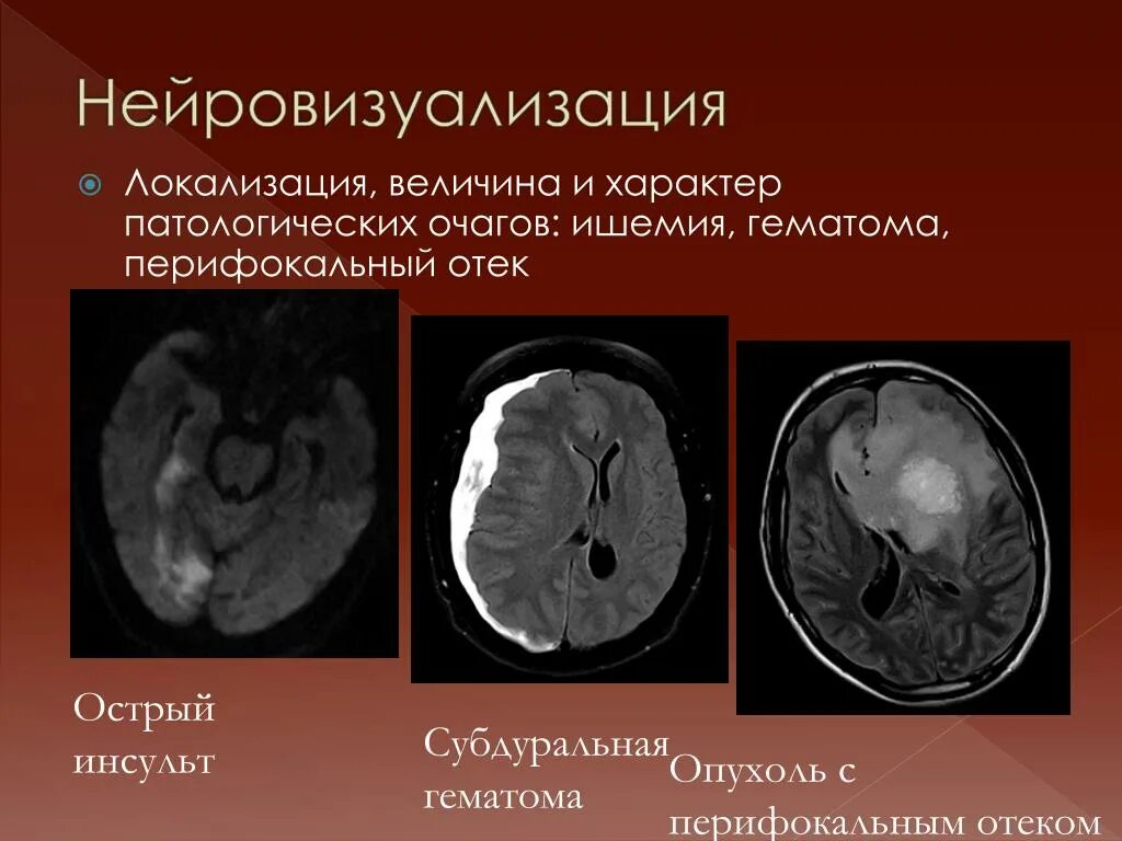 Отек мозга g 93.6 причина. Перифокальный отек мозга на кт. Нейровизуализация отека мозга. Перифокальный вазогенный отек.