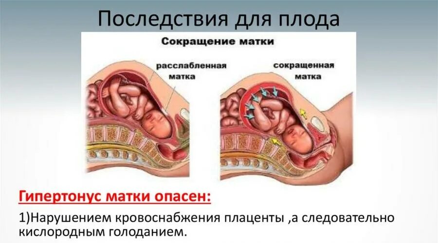 Гипертонус Матки Можно Заниматься Сексом