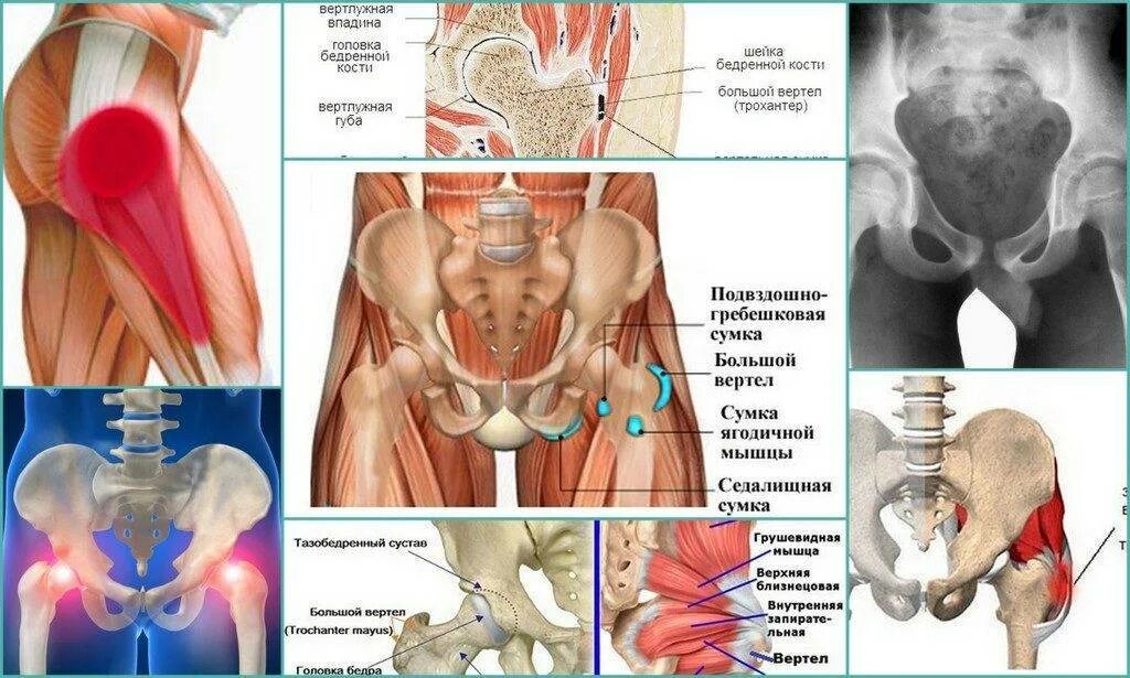Болит бедро операция. Бурсит трохантерит тазобедренного сустава. Трохантерита тазобедренного сустава симптомы. Трохантерит тазобедренного сустава . Сухожилия. Бурсит подвздошно-Гребешковой сумки тазобедренного сустава.