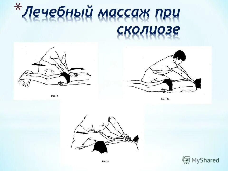 Можно делать при сколиозе массаж. Массаж при сколиозе. методика массажа при сколиозе. массаж при сколиозе 2 степени. приемы массажа при сколиозе.