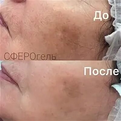 Контурная пластика глаз (филлеры под глаза) - сделать уколы филлеров от темных к