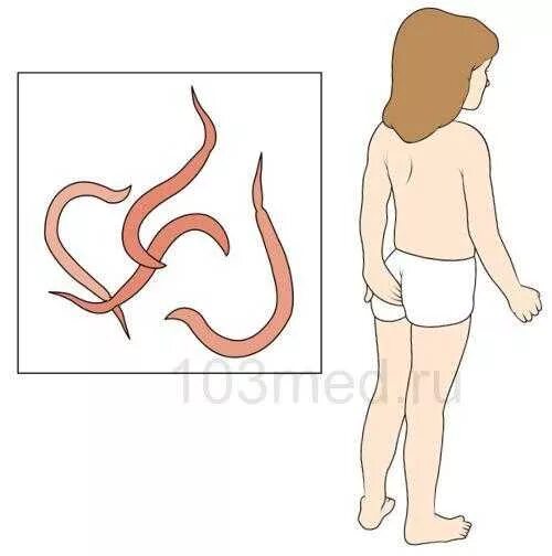 У ребенка 7 лет острицы. Острица детская enterobius vermicularis. Острица детская размеры. Причины заражения энтеробиозом острицы. Энтеробиоз острицы у детей.