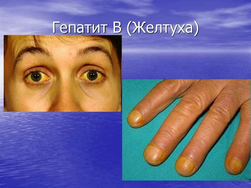 Желтизна у человека