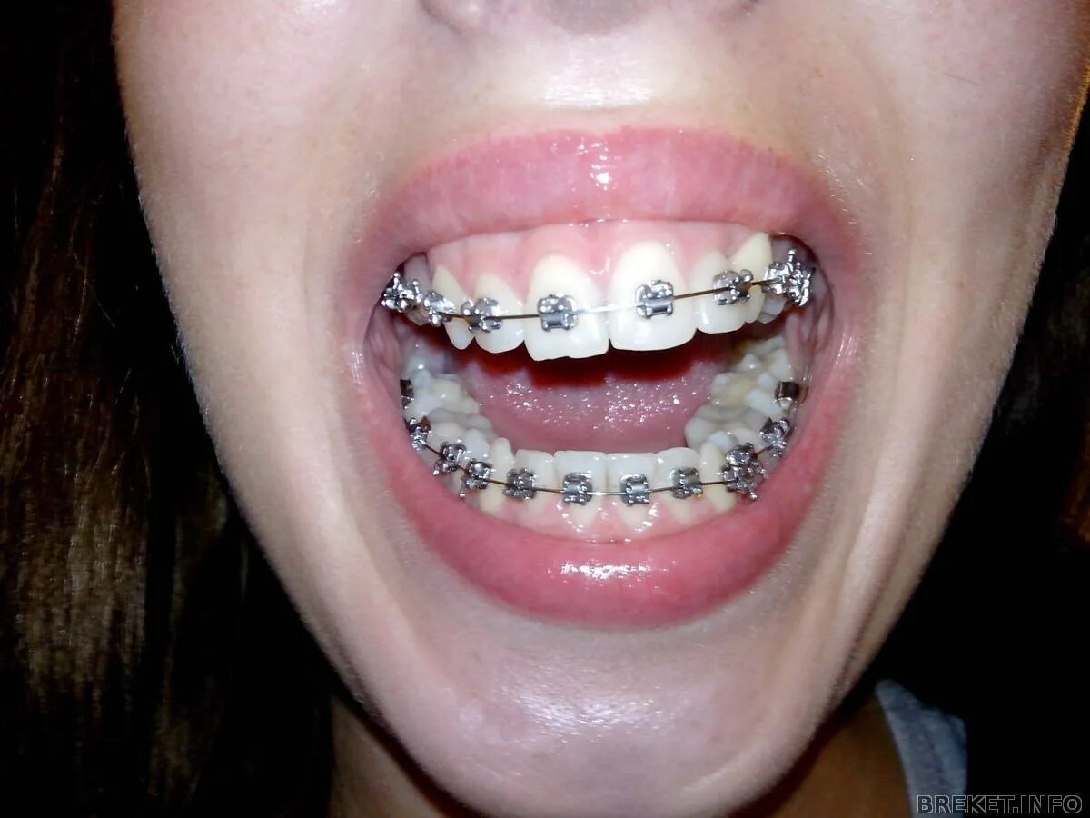 Вылетела дуга из последнего брекета. Вылетела дуга из брекета. Проф гигиена с брекет системой. Вылетела дуга из брекета. Выскочила дуга из брекета.