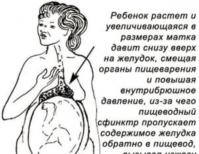 Изжога во 2 триместре. Изжога при беременности 3 триместр. Симптомы изжоги при беременности 2 триместр. Желудок при беременности. Изжоге прибеременночти.