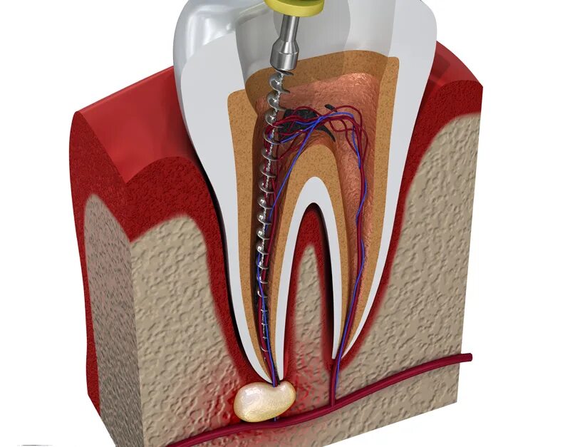 Расширитель зубных каналов. Обработка и пломбирование корневых каналов