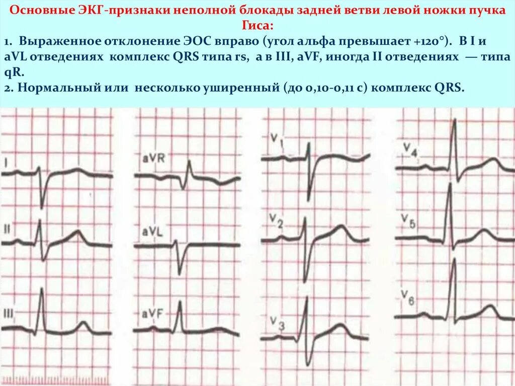 Блокада левой задней ножки. Полная блокада левой ножки пучка Гиса на ЭКГ. ЭОС при неполной блокаде правой ножки пучка Гиса. Полная блокада левой ветви пучка Гиса на ЭКГ. Блокада левой ножки пучка Гиса на ЭКГ.