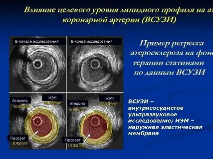 Узи бляшек сосудов