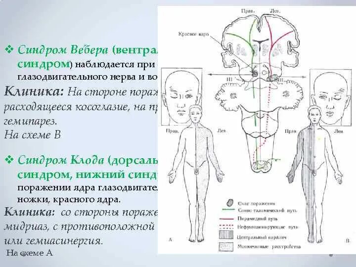 Оптико пирамидный синдром. Альтернирующий синдром вебера неврология. альтернирующие синдромы глазодвигательного нерва. синдром поражения глазодвигательного нерва.