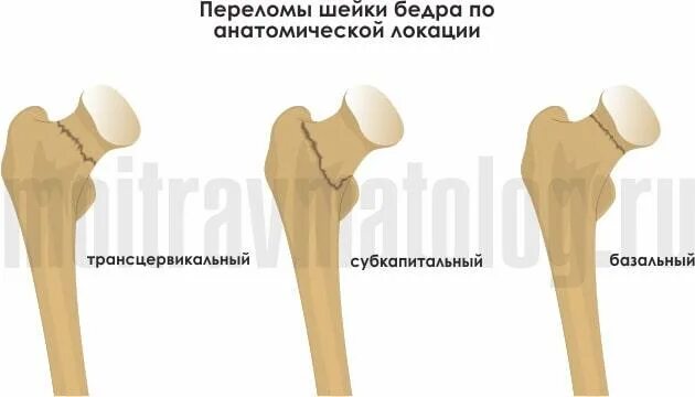 Вколоченный перелом шейки бедренной кости рентген. Субкапитальный перелом шейки бедра. Классификация гардена перелом шейки бедра. Базисцервикальный перелом шейки бедра рентген. Аддукционный перелом шейки бедренной кости.