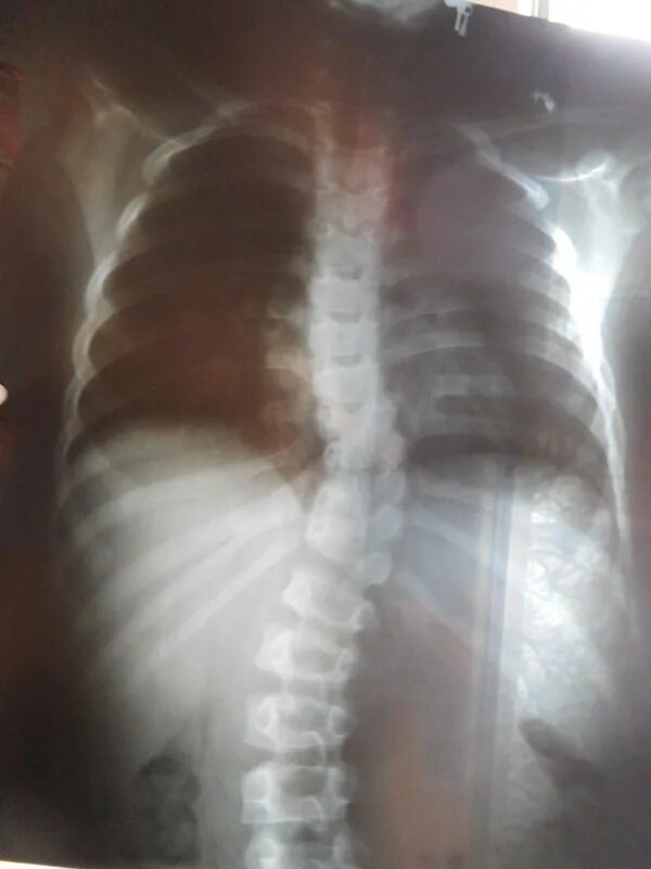 Окончатый перелом ребер рентген. Консолидация ребер на рентгене. Перелом ребра со спины. Перелом 9 10 11 ребра слева рентгенограмма. Перелом ребра 9 10 9-10 слева.