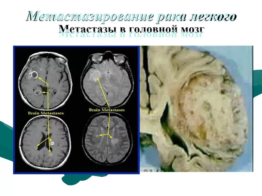 Рак мозга степени. Метастатические опухоли легких.