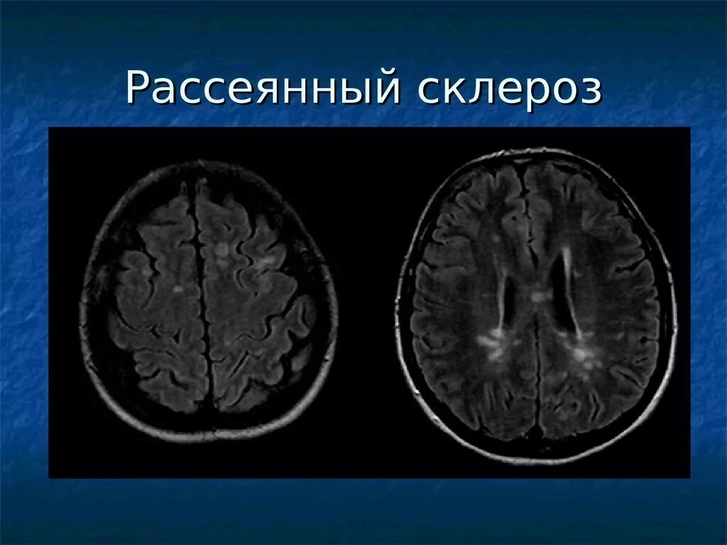 Склероз мозга. Рассеянный склероз. Рассеянный склероз демиелинизация. Рассеянный множественный склероз. Рассеянный склероз (РС) -.