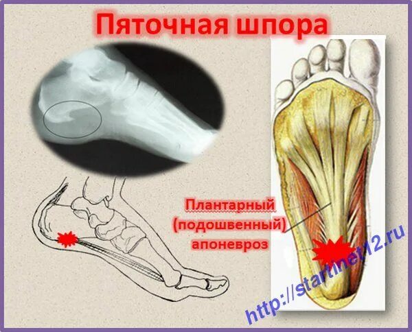 Пяточная шпора проходит сама по себе. Пяточная шпора проходит сама по себе