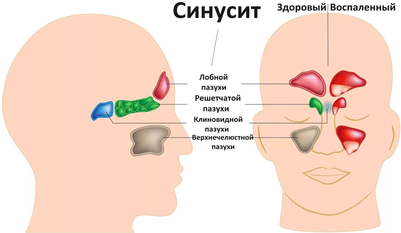 Болит нос при простуде. Синусит лобной пазухи фронтит. Острый сфеноидальный синусит. Острые и хронические синуситы. Фронтит гайморит пазухи.