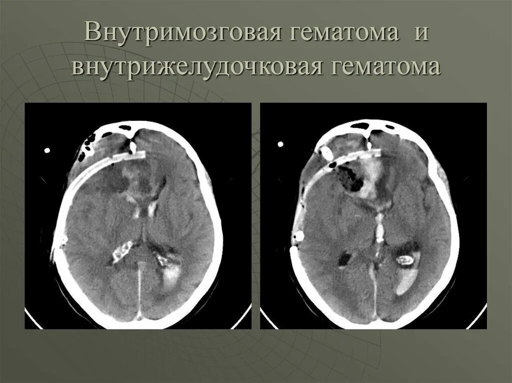 Внутримозговая гематома классификация кт. Внутрижелудочковые гематомы на кт. Внутрижелудочковая гематома головного мозга. Кт мозга внутримозговая гематома. Кровоизлияние в желудочки