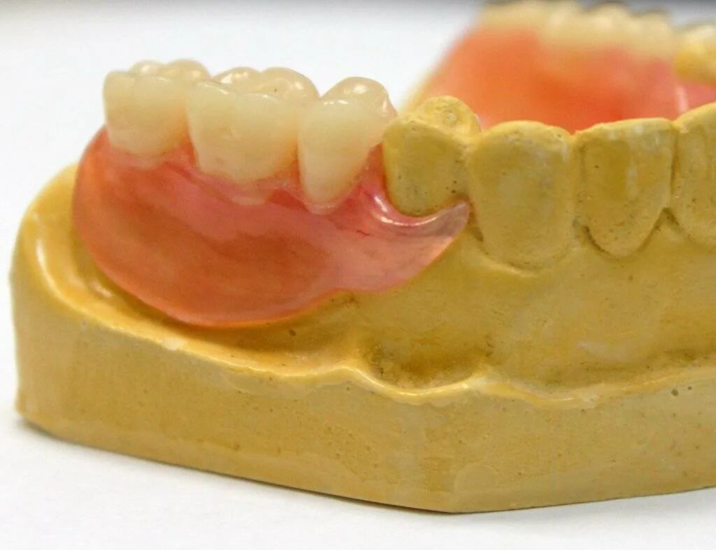 пластиночный протез на верхнюю челюсть. моделировка нейлонового протеза. обычный съемный протез. съемный протез (6-14 зубов) термо джет. обычный съемный протез.