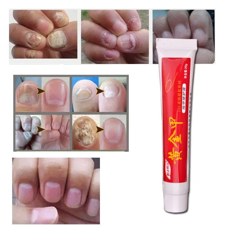 Китайское средство от грибка ногтей Nail fungus. Онихомикоз ( обработка грибковых ногтей). Мазь для грибка ногтей на руках.