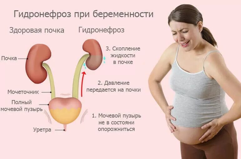 37 недель тянет живот и поясницу. Гидронефроз при беременности. Почки при беременности. Почки беременной женщины. Мочевой пузырь у беременных расположение.