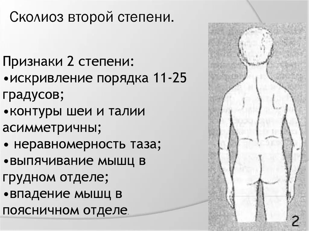 Сколиоз 2 степени симптомы. Сколиоз позвоночника 2 степени. Сутулость сколиоз 2 степени. Сколиоз 2 степень у грудничка. Сколиоз 2 степени это