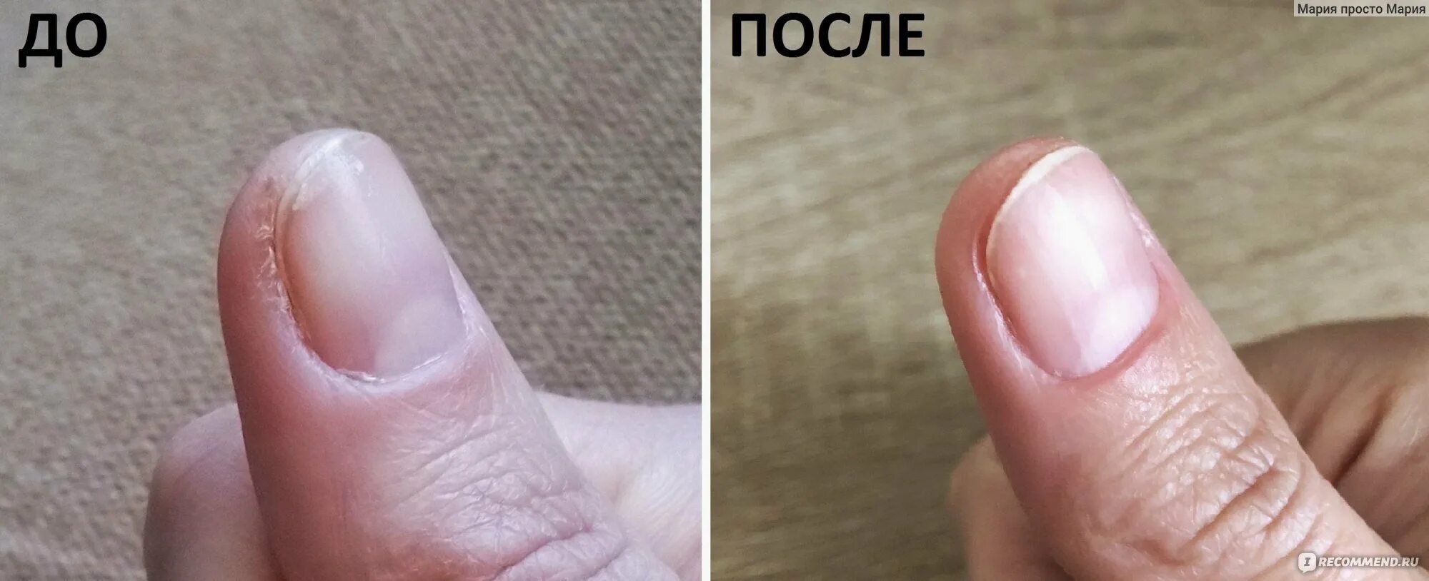 Боковые трещины ногтя на руке
