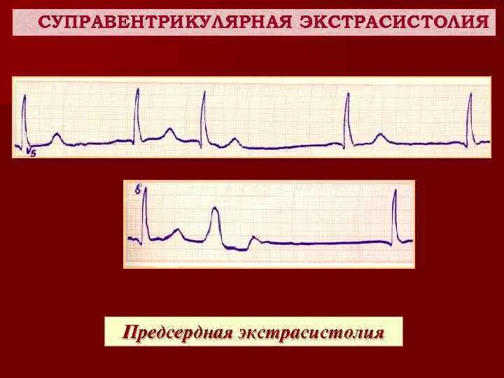 Суправентрикулярная экстрасистолия экг критерии. Единичные суправентрикулярные экстрасистолы. Групповая наджелудочковая экстрасистолия на экг. Частые суправентрикулярные экстрасистолы экг. Наджелудочковая пароксизмальная экстрасистолия экг.
