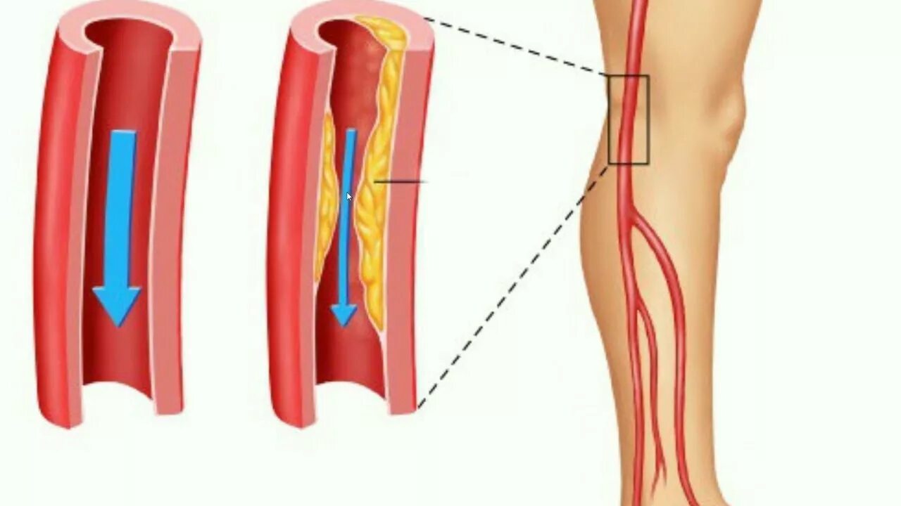 Облитерирующий атеросклероз сосудов конечностей. Облитерирующий атеросклероз артерий нижних конечностей. Облитерирующий атеросклероз сосудов нижней конечности 2,. Облитерирующий атеросклероз нижних конечностей причины. Тромб в сосудах нижних