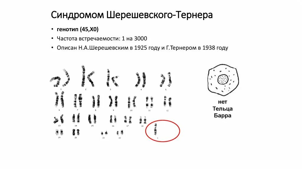Синдром тернера мкб 10. Синдром шерешевского тернера кариотип. синдром шерешевского тернера генотип. синдром шерешевского тернера тельца барра. тельца барра при синдроме шерешевского тернера.