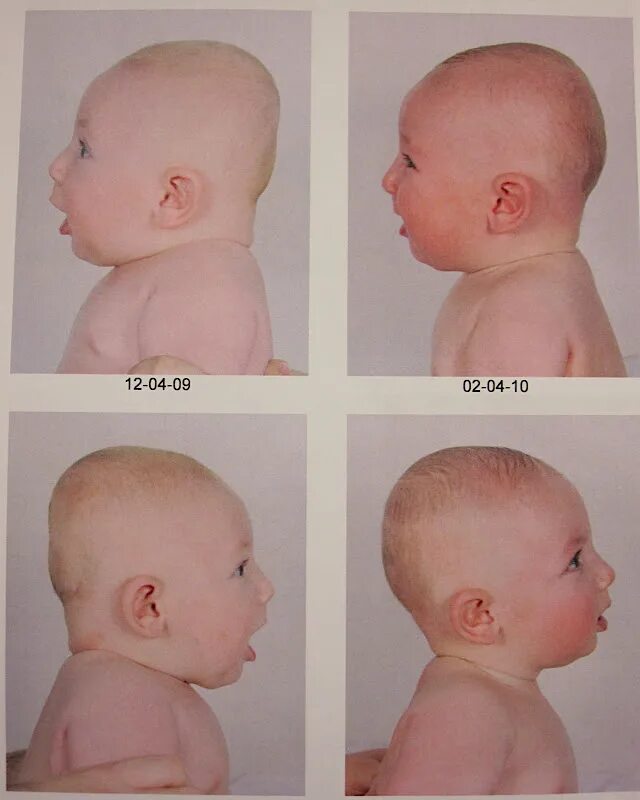 Изменилась форма головы. Скафоцефалия+плагиоцефалия. Правильная форма головы. Голова плоская сзади у грудничка. Долихоцефалическая форма головы новорожденного.