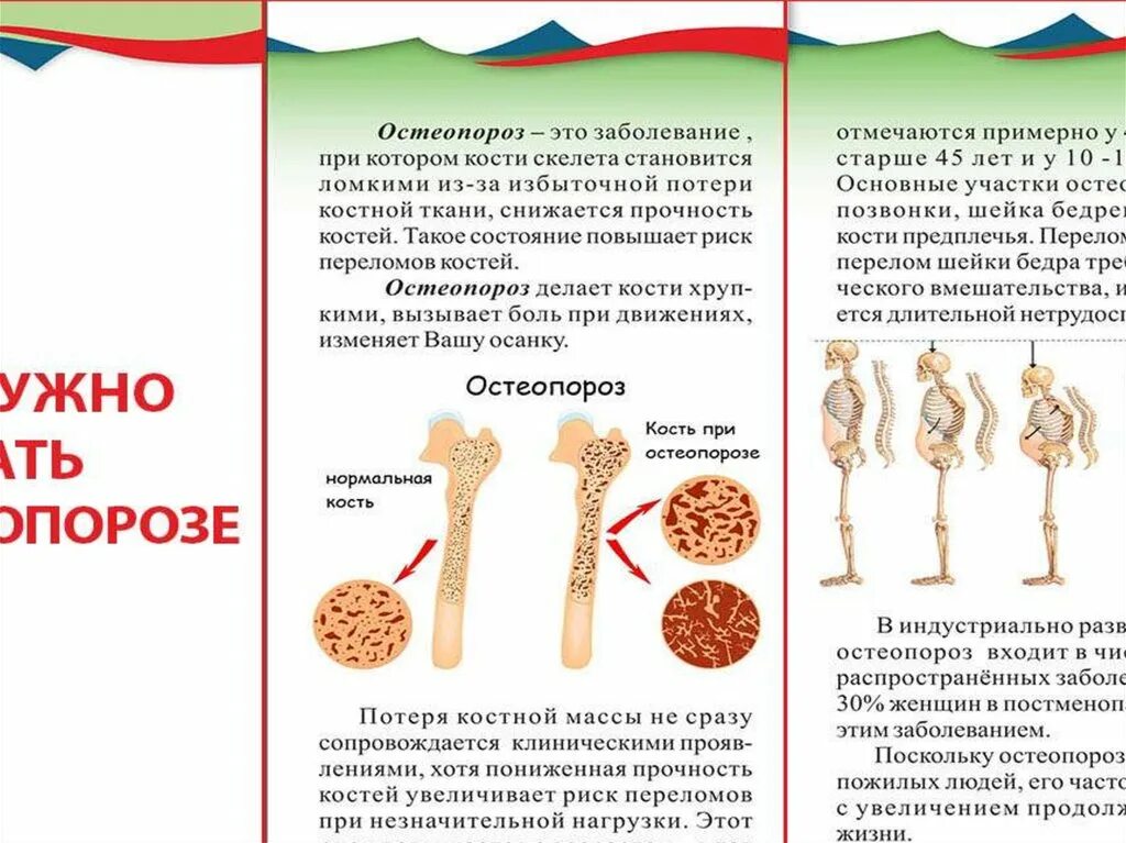 Лечение костных заболеваний. Остеопороз. Заболевание костей остеопороз. Профилактика остеопороза. Кость при остеопорозе.