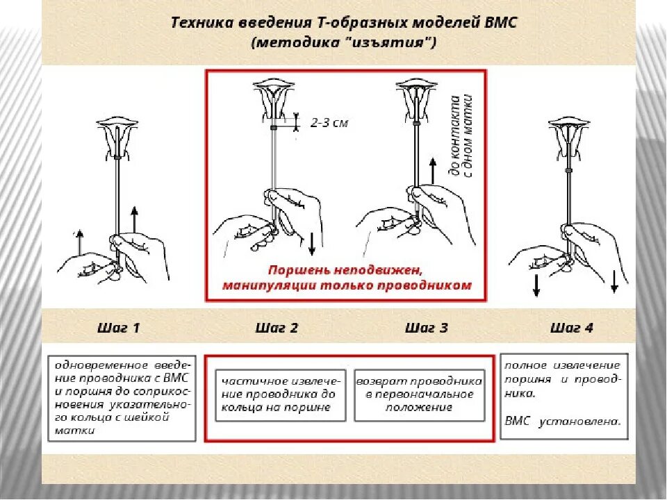 Введение вмс. Техника введения ВИС Мирена. Методика введения внутриматочной спирали. Техника постановки ВМС спирали.