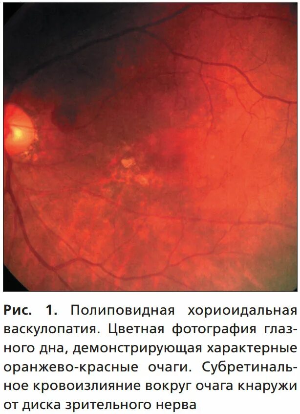 Преретинальное кровоизлияние. Полиповидная васкулопатия это. Субретинальное кровоизлияние сетчатки. Преретинальное и субретинальное кровоизлияние. Васкулопатия это
