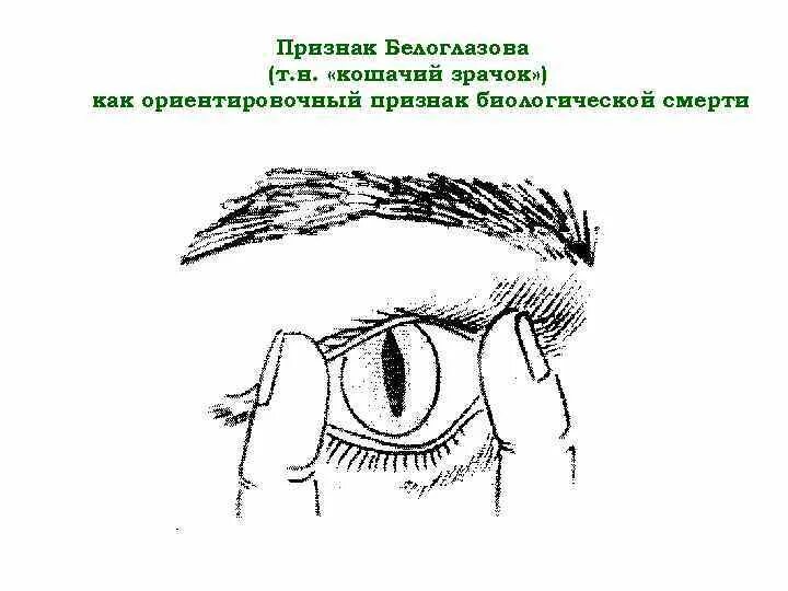 Признаки глазков. Синдром кошачьего глаза при биологической смерти. Признак Белоглазова – «феномен кошачьего зрачка». Кошачий глаз симптом клинической смерти. Кошачий глаз признак клинической смерти.