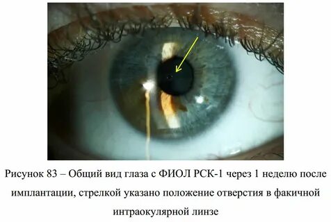 Имплантация линзы отзывы