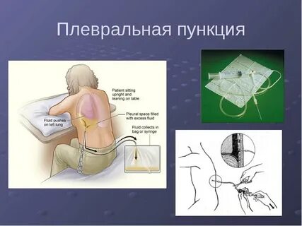 Как часто можно делать пункцию