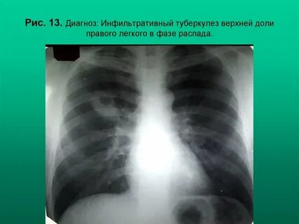 Инфильтрация нижней доли правого легкого
