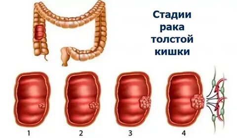 Прямая кишка рак первая стадия