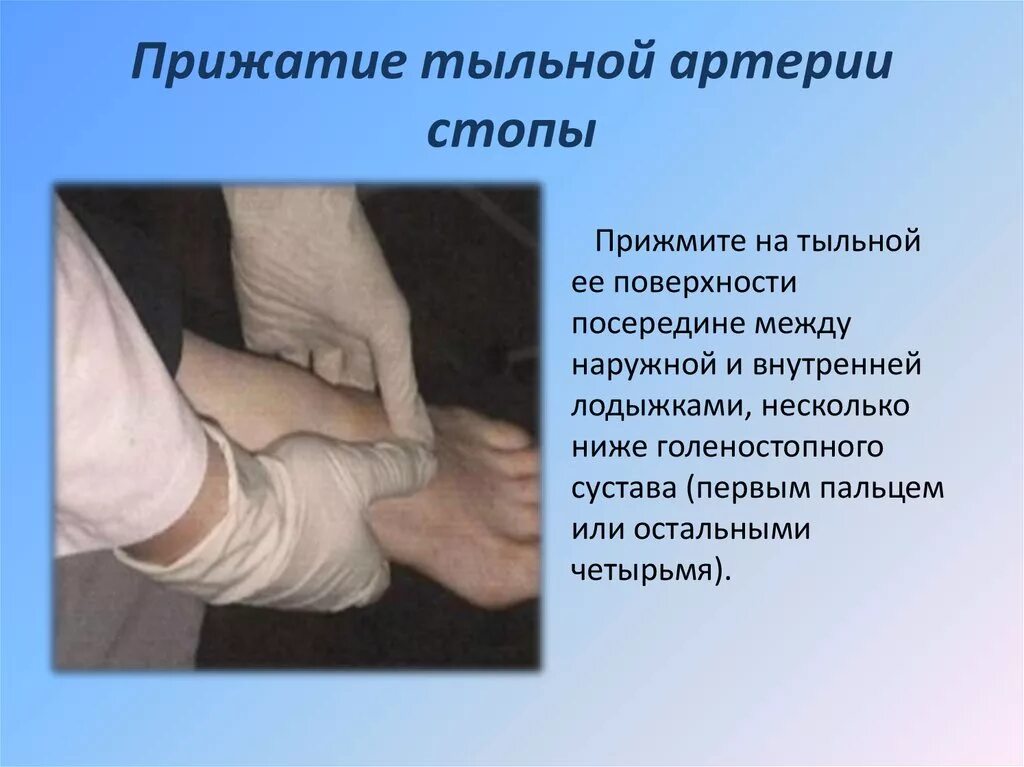 Кровотечение из подколенной артерии. Кровотечение из подколенной артерии