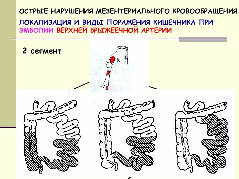 Тромбоз брыжеечной артерии. Острые нарушения мезентериального кровообращения сегменты. острая окклюзия брыжеечной артерии. острое нарушение мезентериального кровообращения клиника. мезентериальный тромбоз патогенез.