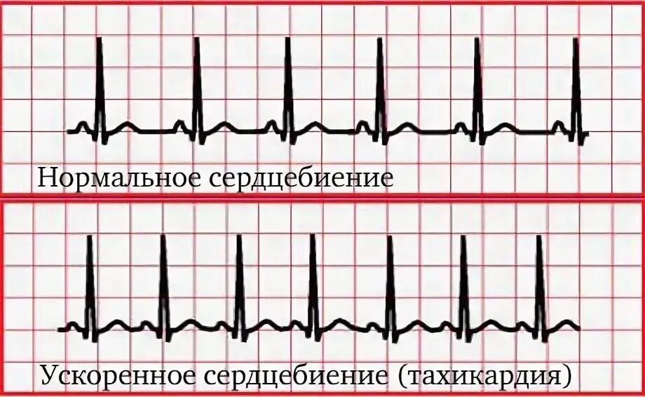 Как должно биться сердце у человека. Удары сердца в минуту у человека. Сколько раз бьется сердце. Как должно биться сердце у человека. Как должно биться сердце у человека.