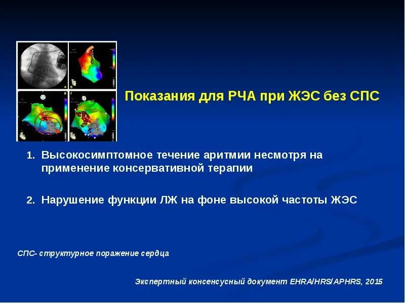 Показания к РЧА. Радиочастотная катетерная абляция сердца. РЧА при Узловой тахикардии.