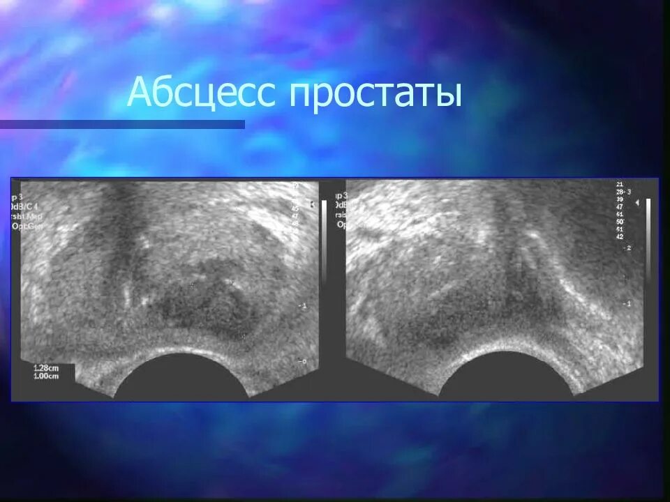 УЗИ предстательной железы. Кисты предстательной железы на УЗИ. Нарушение предстательной железы