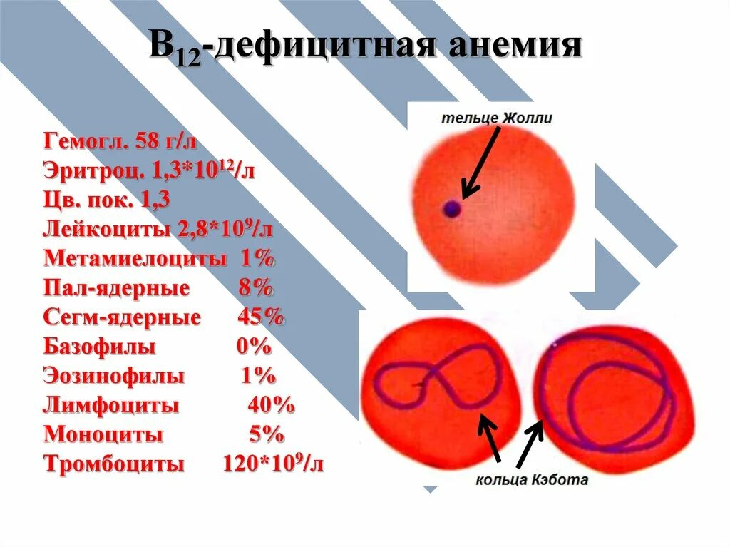 Признаки дефицитной анемии. Гемоглобин при b12 дефицитной анемии. Симптомы при б12 дефицитной анемии. Витамин б12 дефицитная анемия симптомы. Б12 анемия синдромы.