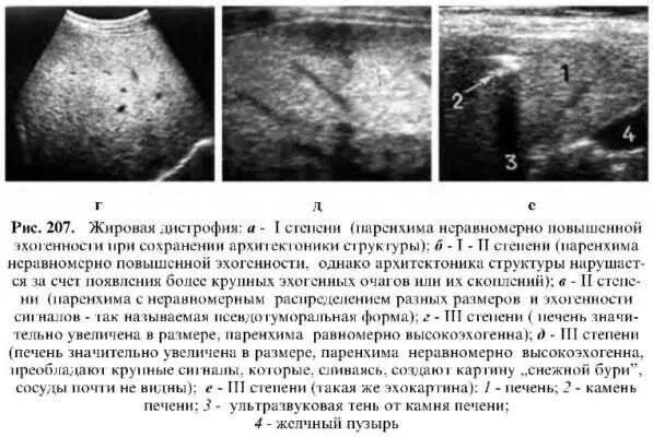 Жировой гепатоз УЗИ признаки. Жировая инфильтрация печени 3 степени. УЗИ признаки жирового гепатоза. УЗИ симптом жирового гепатоза печени.