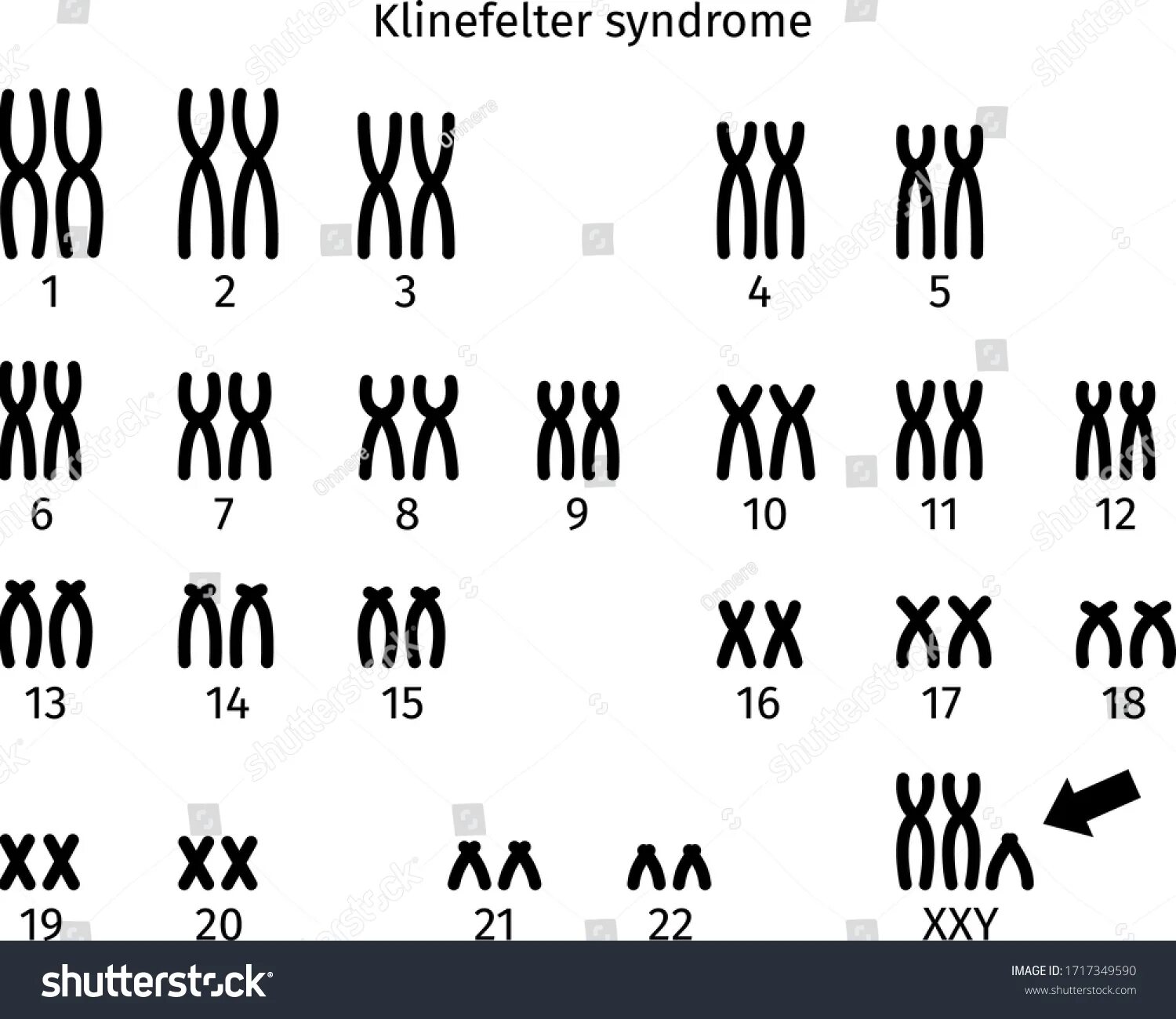 Klinefelter Syndrome karyotype. Клайнфелтер кариотип.