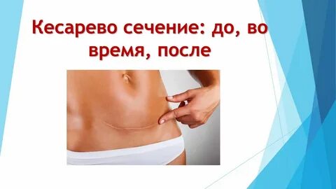 Почему кесарево сечение