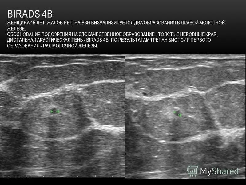 Что означает bi rads 2 узи. Фиброаденома молочной железы birads 4 УЗИ. Строение молочной железы на УЗИ. Образования молочной железы на УЗИ. УЗИ молочных желез лекция.